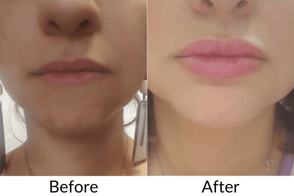 Lip Filler Before And After | Royal Medical Health in Albuquerque
