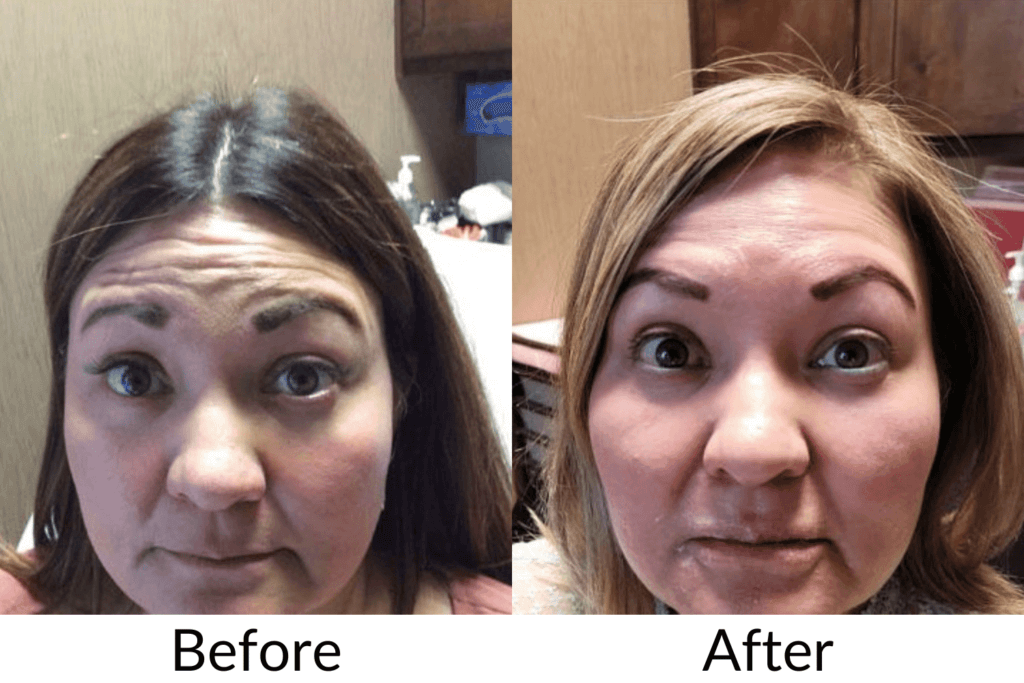 Forehead Botox Before and After | Royal Medical Health in Albuquerque