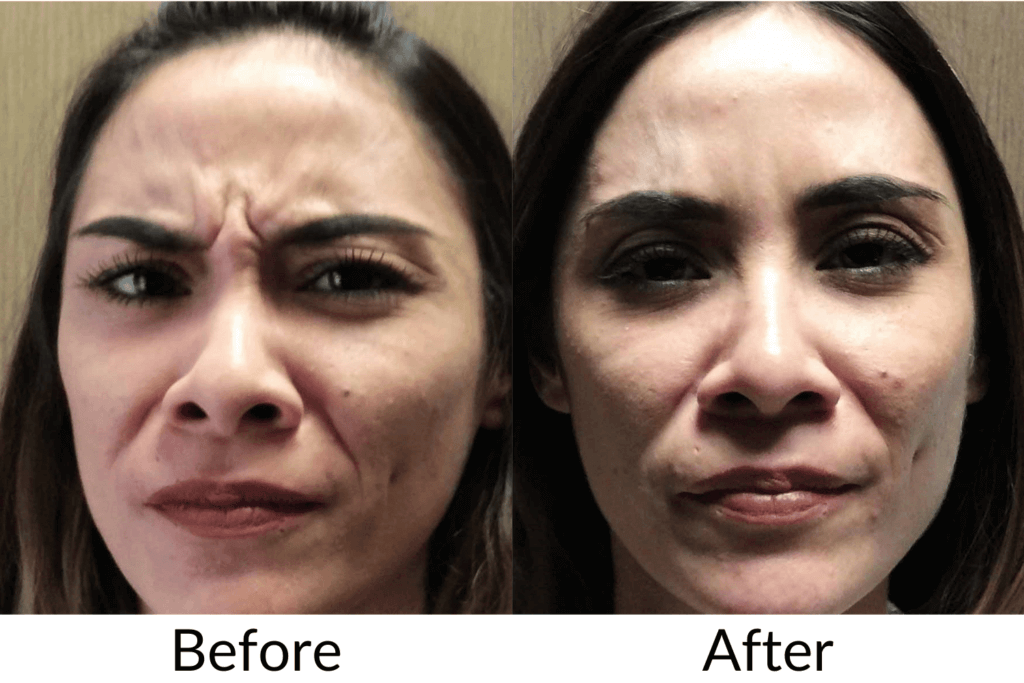 Frown Dysport Before and After | Royal Medical Health in Albuquerque