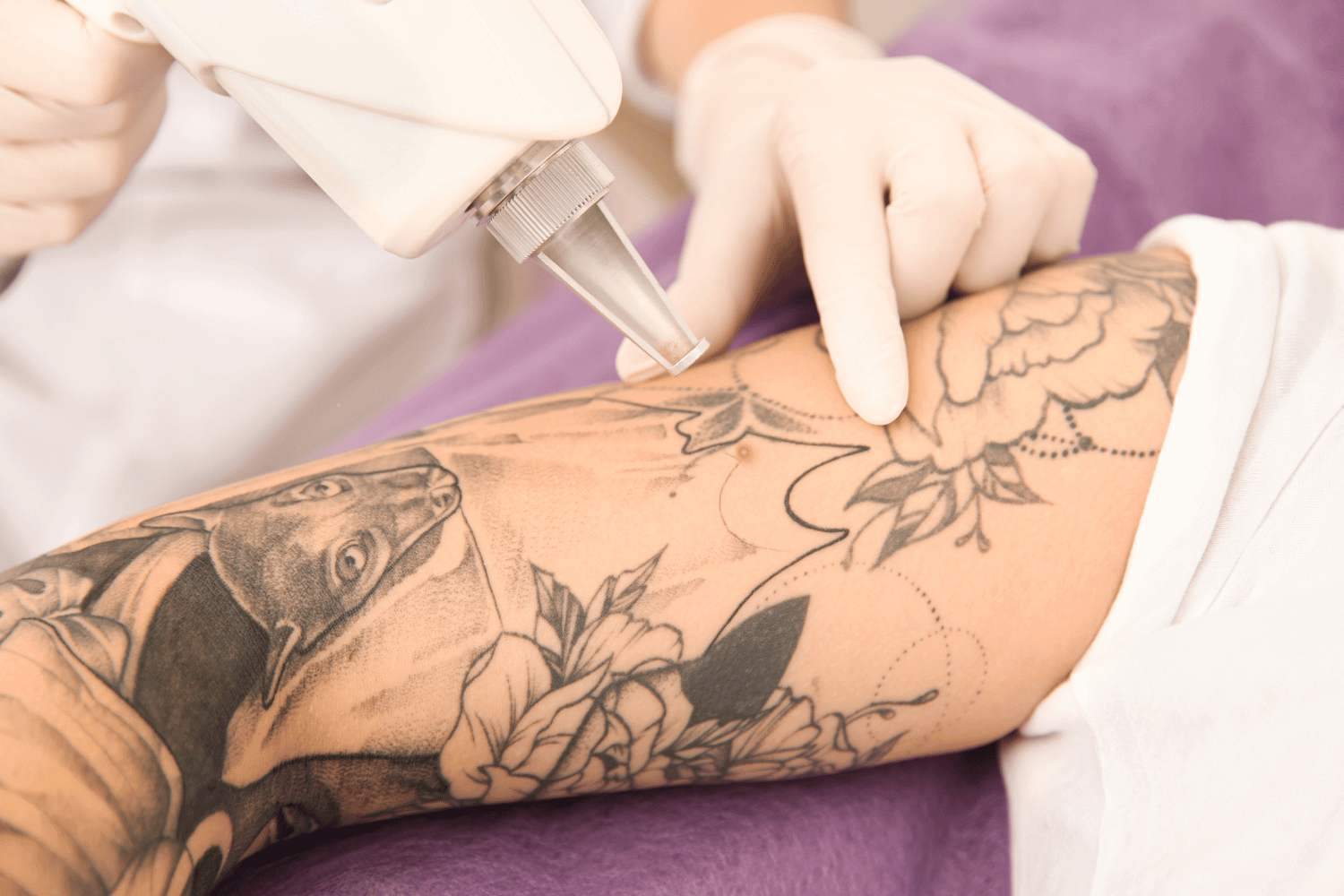 Benefits of Laser Tattoo Removal | Albuquerque | Royal Medical Health