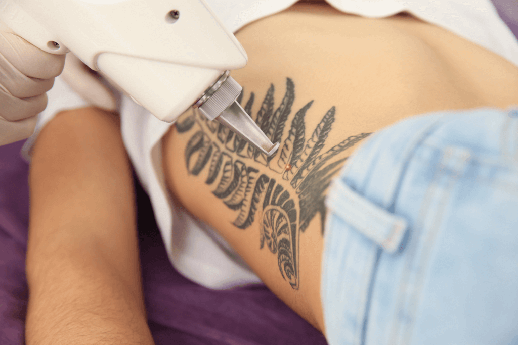 Laser Tattoo Removal Services | Albuquerque | Royal Medical Health