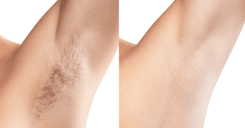 Before and after laser hair removal on legs, showing a dramatic reduction in hair growth.