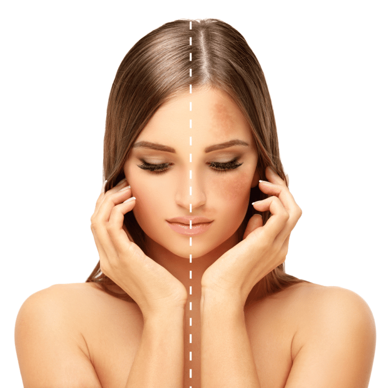 IPL Treatment in Albuquerque | Photofacial | Royal Medical Health