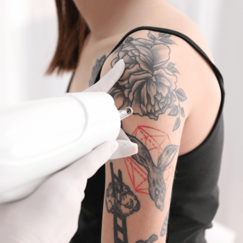 Laser Tattoo Removal Sale in Albuquerque, NM at Royal Medical Health