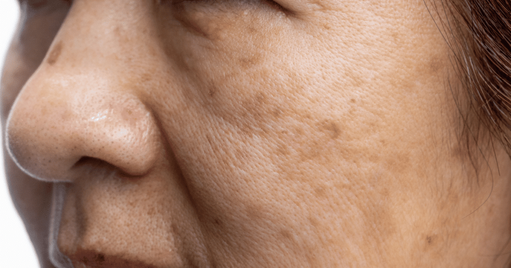 Close-up of sunspots on a person's face.