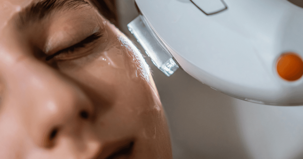 A person receiving IPL treatment to reduce sunspots.