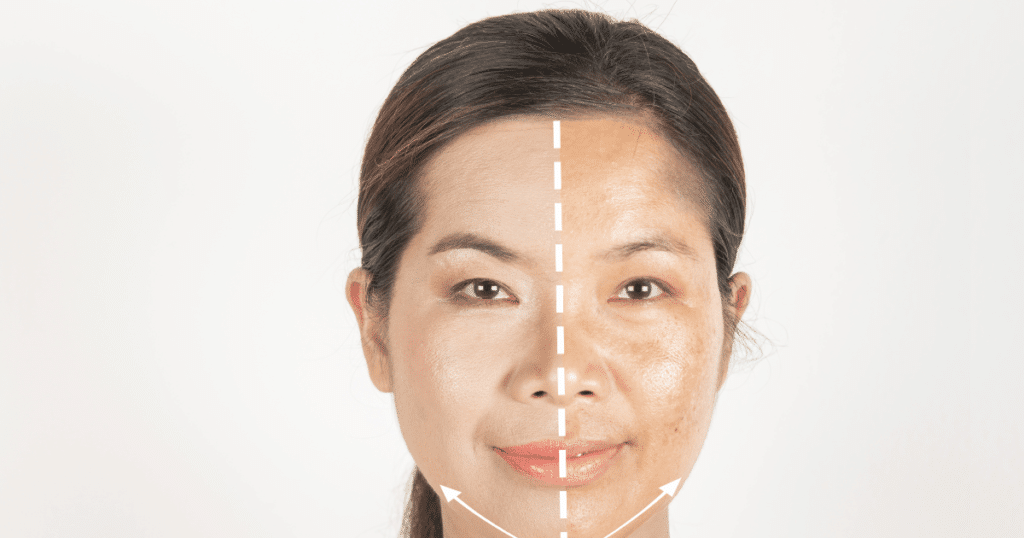 Before-and-after photos showing the effectiveness of IPL treatment for sunspots.