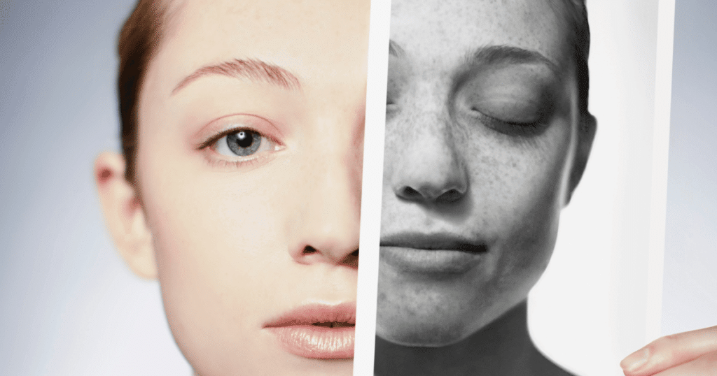 A woman holding a photograph showing sun spot damage to her face and a comparison to her face after microneedling.