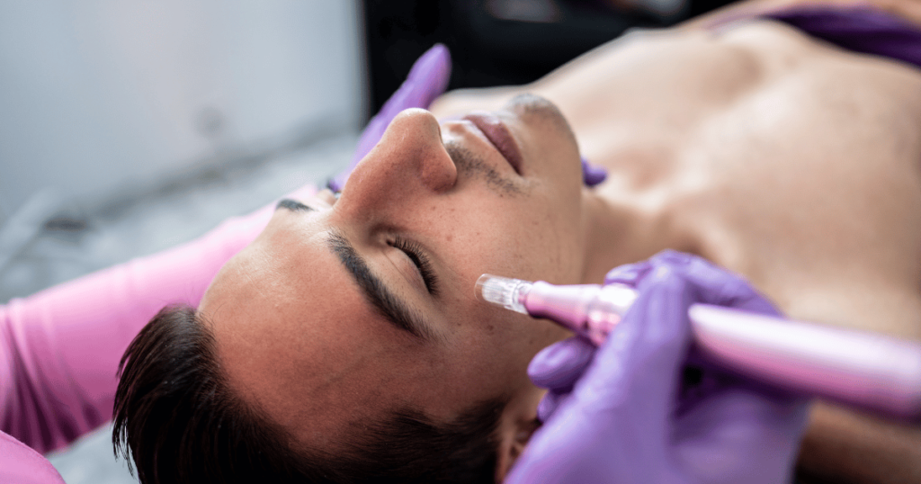 A man getting a microneedling for sun spots treatment at Royal Medical Health in Albuquerque, NM.