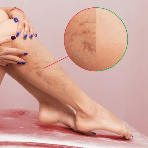 Spider Vein Removal Sale in Albuquerque at Royal Medical Health