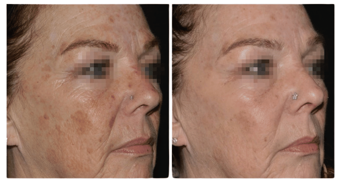 LaseMD Ultra before and after — representative melasma clinical result | Royal Medical Health Albuquerque