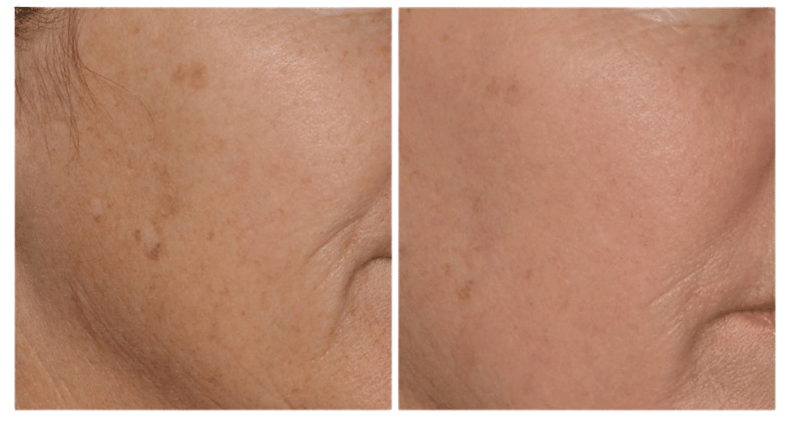 LaseMD Ultra before and after — representative sun spot clinical result | Royal Medical Health Albuquerque