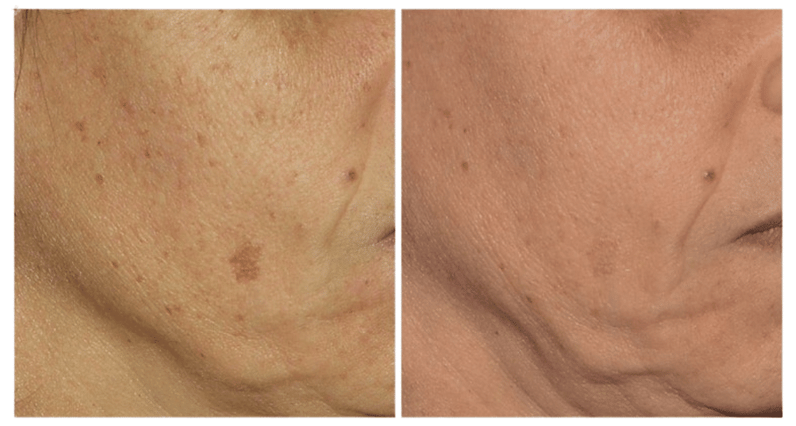 LaseMD Ultra before and after — representative age spot clinical result | Royal Medical Health Albuquerque